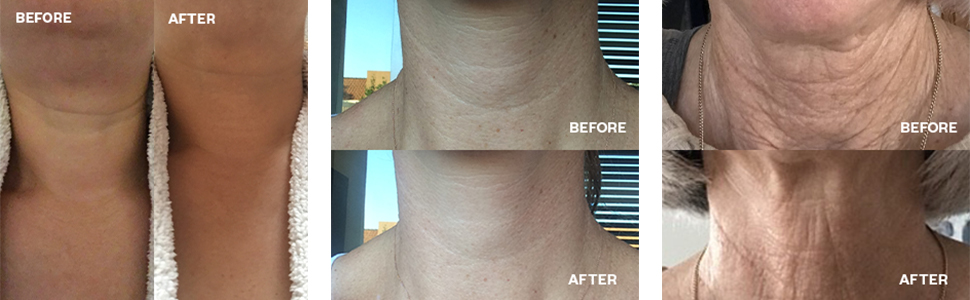 The neck silicone patch before and after. Amazon.com